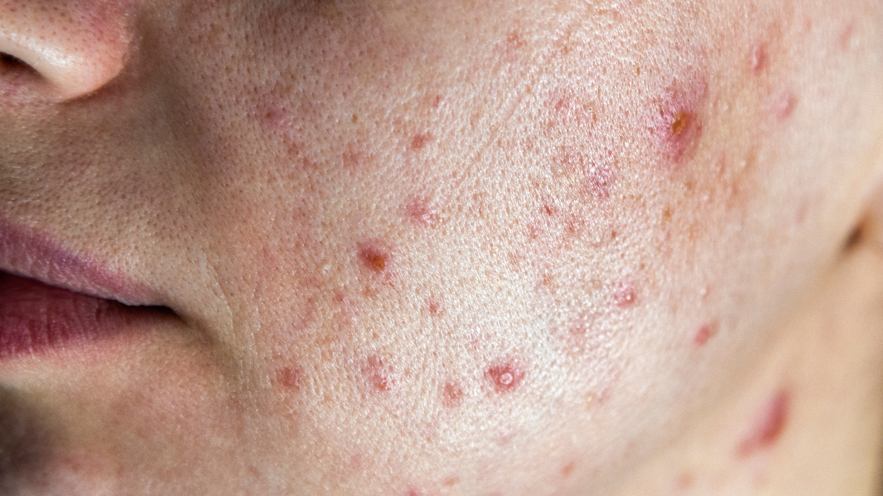 What In Your Everyday Diet Really Affects Acne? Separating Myths From Facts